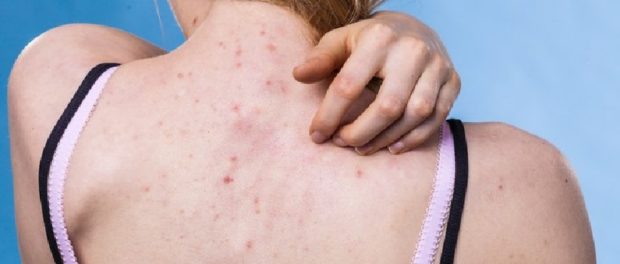 acne en la espalda tratamiento natural