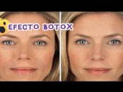 botox natural para la cara
