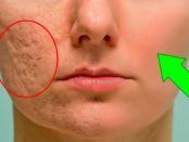 recetas caseras para las cicatrices del acne