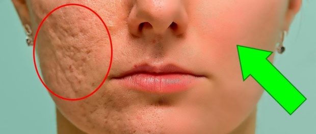 recetas caseras para las cicatrices del acne